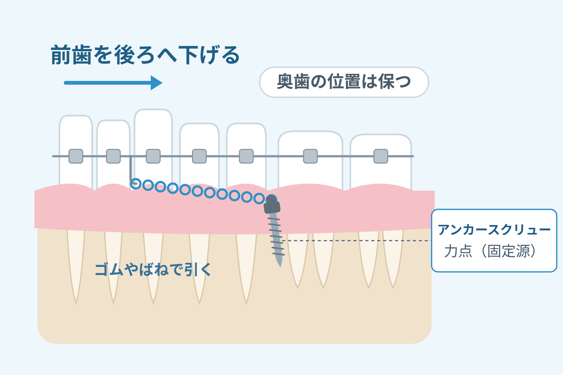 アンカースクリューを固定源にして、奥歯の位置を保ったまま前歯を後ろへ下げる仕組みの図