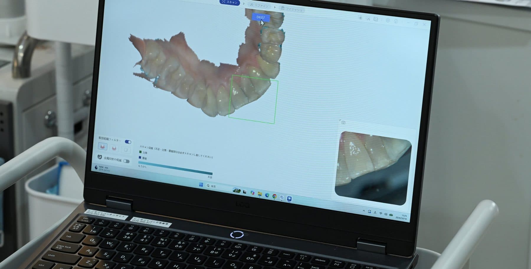 口腔内スキャナーで取り込んだ歯並びの3Dデータ