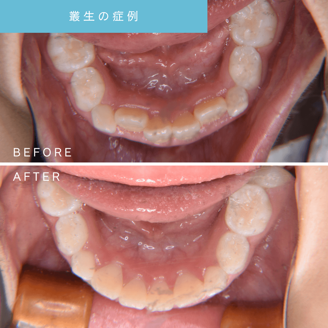 叢生の小児矯正治療前後を比較した口腔内写真