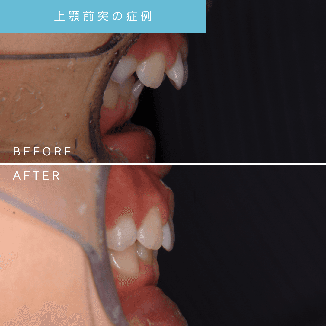上顎前突の小児矯正治療前後を比較した口腔内写真