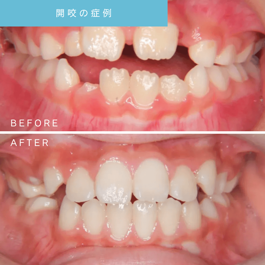 開咬の小児矯正治療前後を比較した口腔内写真