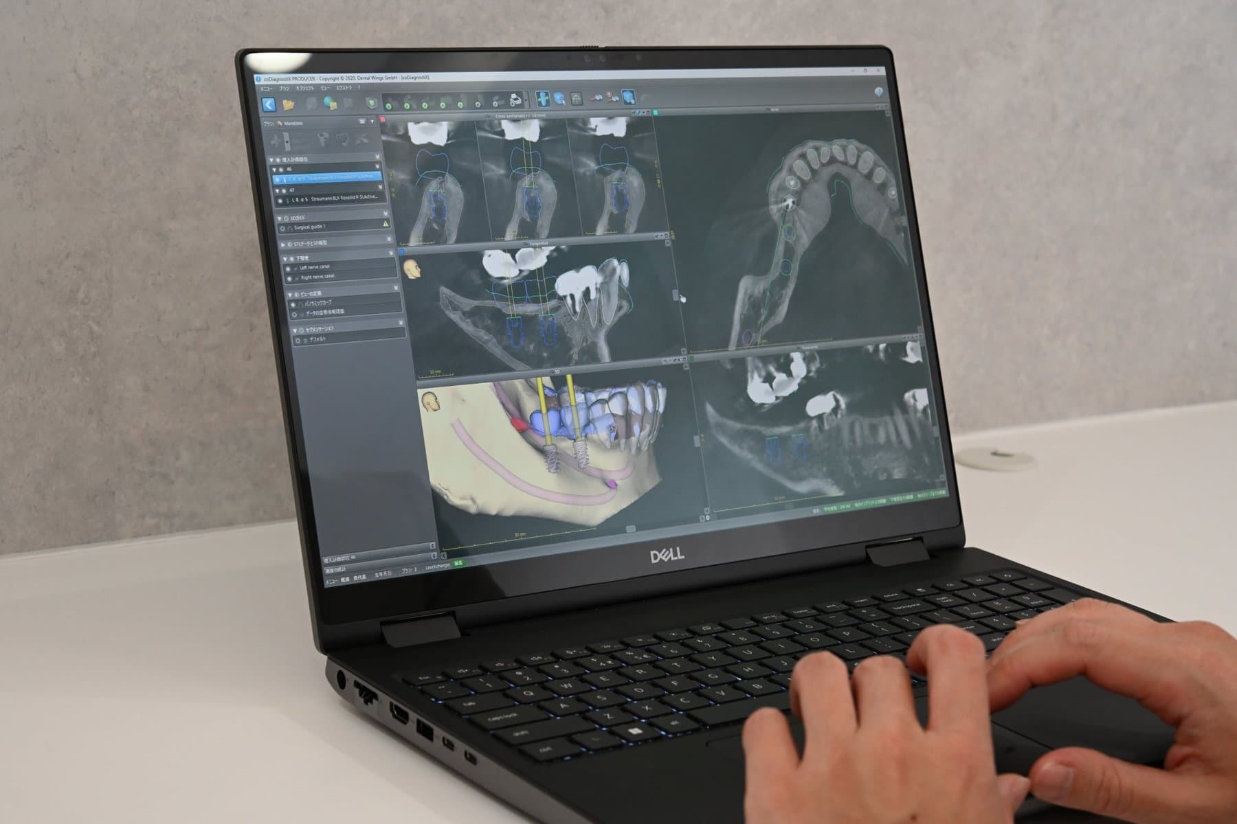 CTデータを使ったインプラントの治療計画ソフトを操作する歯科医師